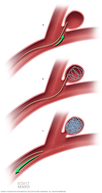 Image to demonstrate coil embolization. The image has three frames, with each including an image of a blood vessel with an aneurysm. A gray wire indicating the coil in the image shows the coil being inserted into the aneurysm with a catheter and the coil filling up the volume of the aneurysm.